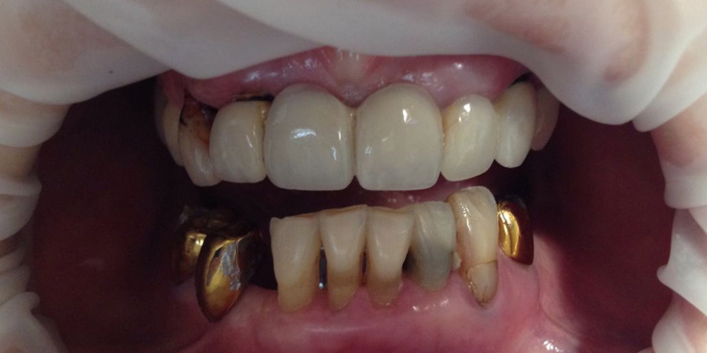 Пациент Б., 68 лет. Фото до начала работы. В полости рта находятся старые протезы. Результат протезирования зубов верхней и нижней челюсти