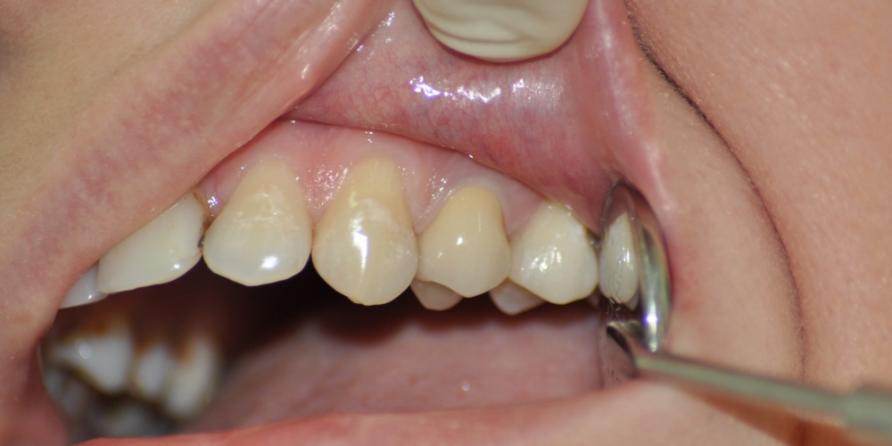  Зуб восстановлен металлической культевой вкладки и м/к коронки