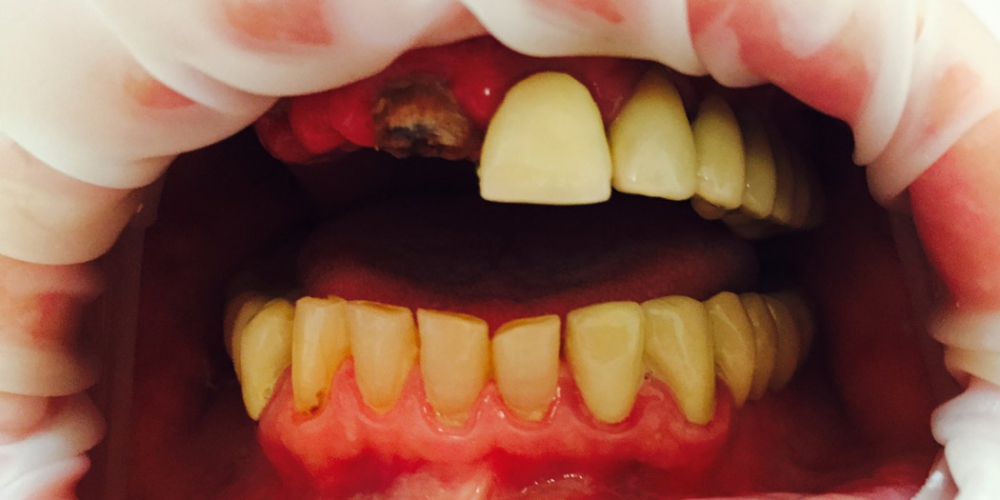 Фото до начала работы. Зубы на верхней челюсти слева отсутствуют, виден разрушенный кариесом центральный зуб. Результат протезирования металлокерамическими коронками, верхняя челюсть