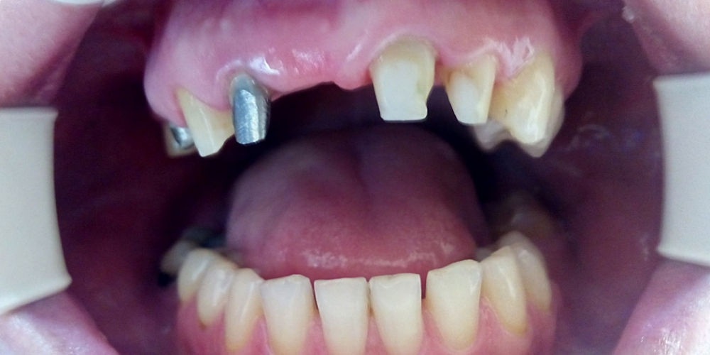 Пациент Ц., 30 лет. Проведено компьютерное моделирование. Разрушенные зубы восстановлены корневыми штифтовыми вкладками. Проведена обработка зубов. Получены слепки.  Протезирование зубов верхней челюсти металлокерамическим мостовидным протезом