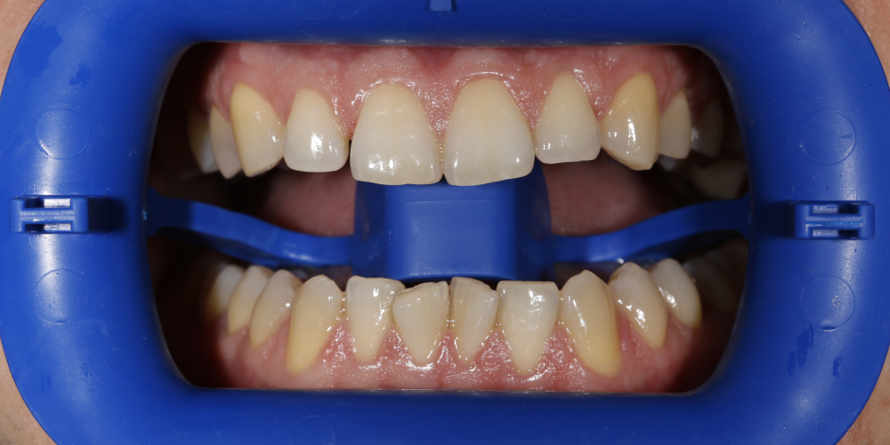  Проведена процедура отбеливания зубов Zoom 3