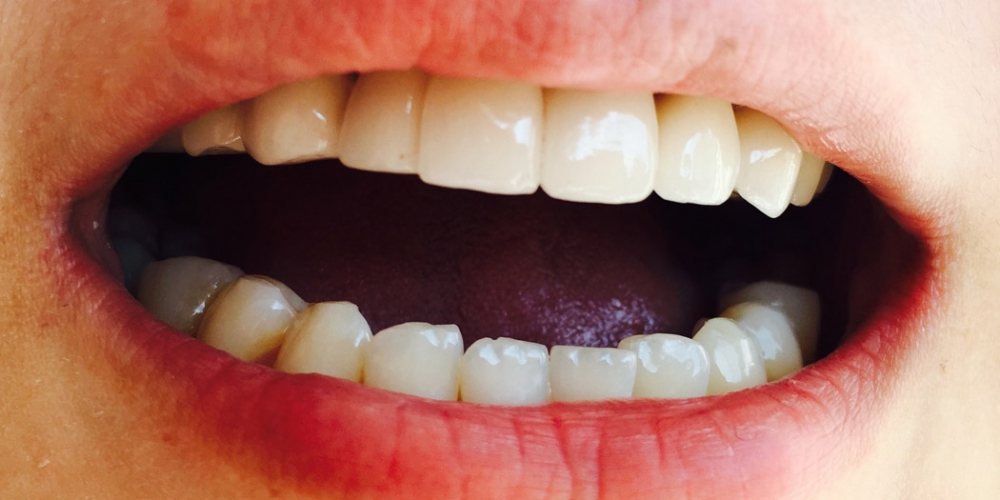 Пациент П., 22 лет, Изготовленный несъемный металлокерамический мостовидный протез зафиксирован в полости рта. Протезирование верхней челюсти металлокерамическим мостовидным протезом