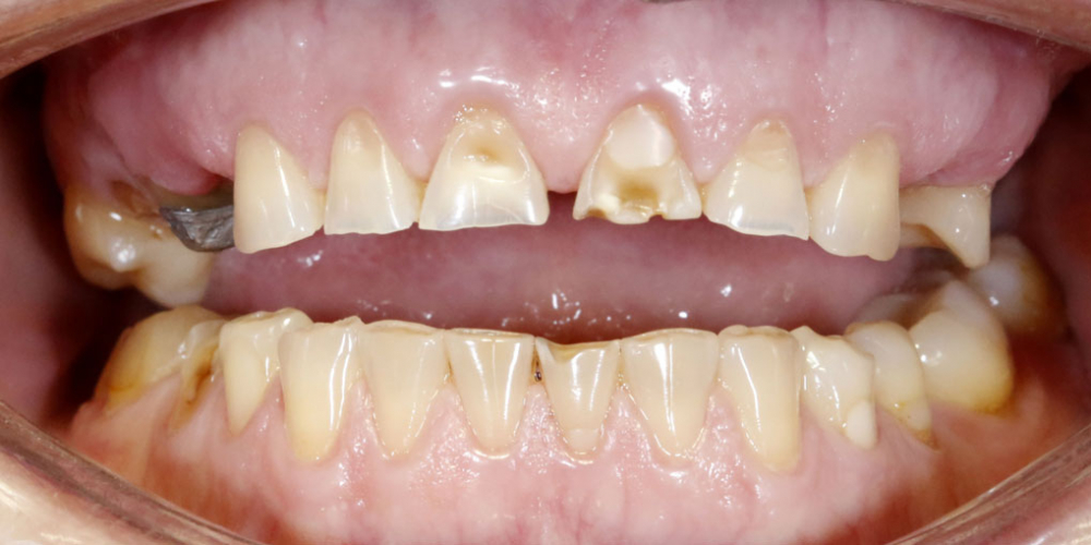  Восстановление верхних зубов керамическими коронками на основе диоксида циркония