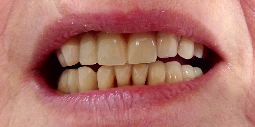 Пациент после проведенного лечения. Разрушенные зубы восстановлены корневыми штифтовыми вкладками. Протезирования зубов верней и нижней челюсти