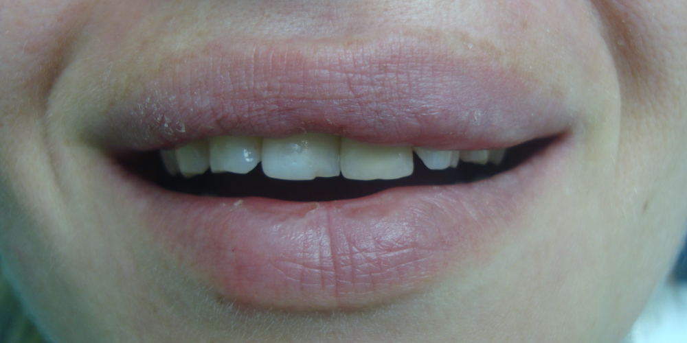  Преображение цвета и формы передних зубов (верхний ряд)