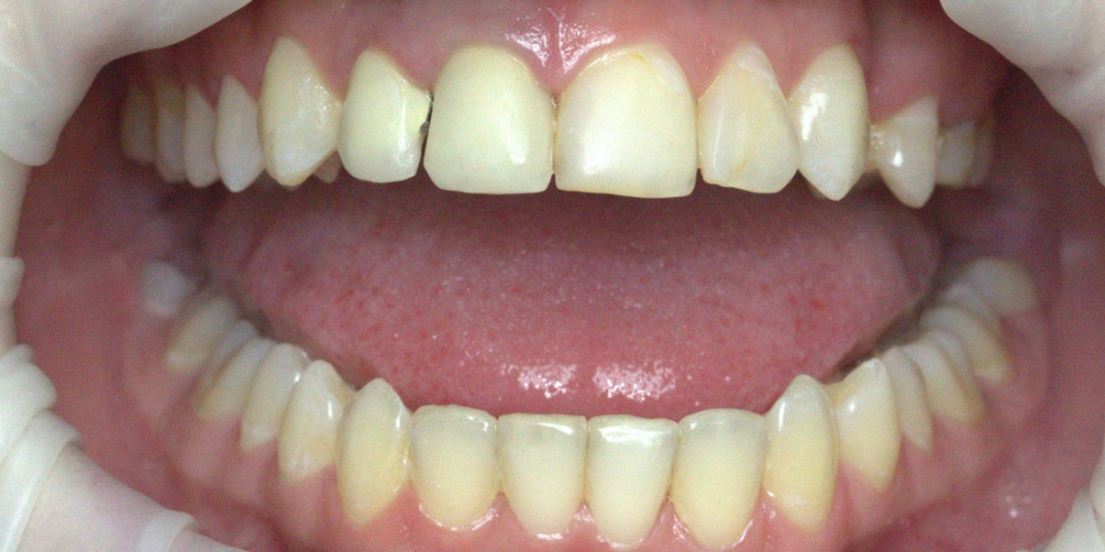  Коронки из диоксида циркония на центральные зубы