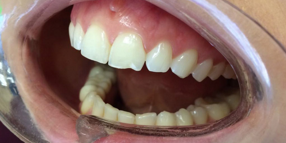  Неинвазивная реставрация скола переднего зуба