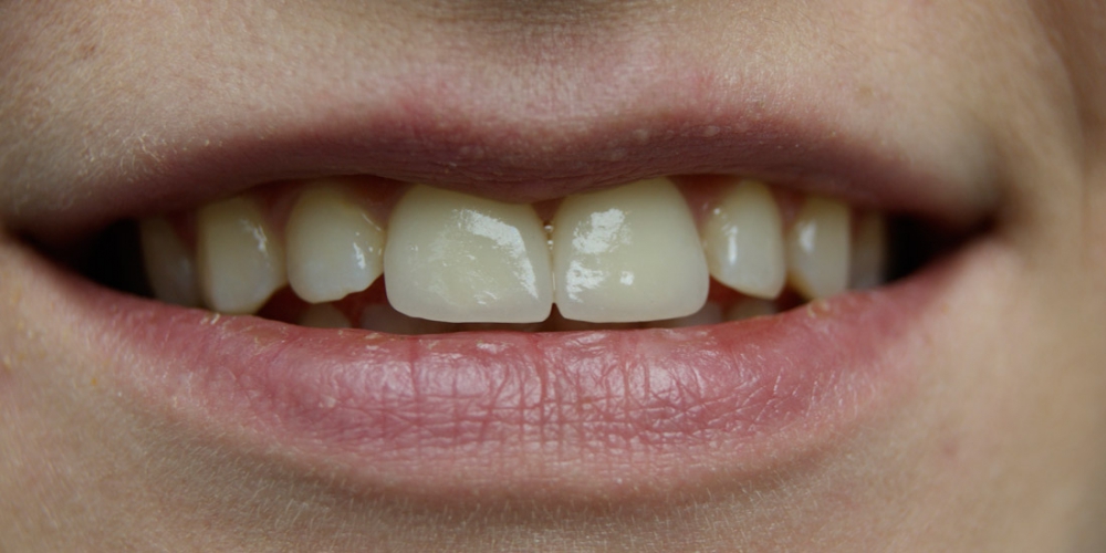  Керамические виниры с закрытием щели между зубами (диастема)