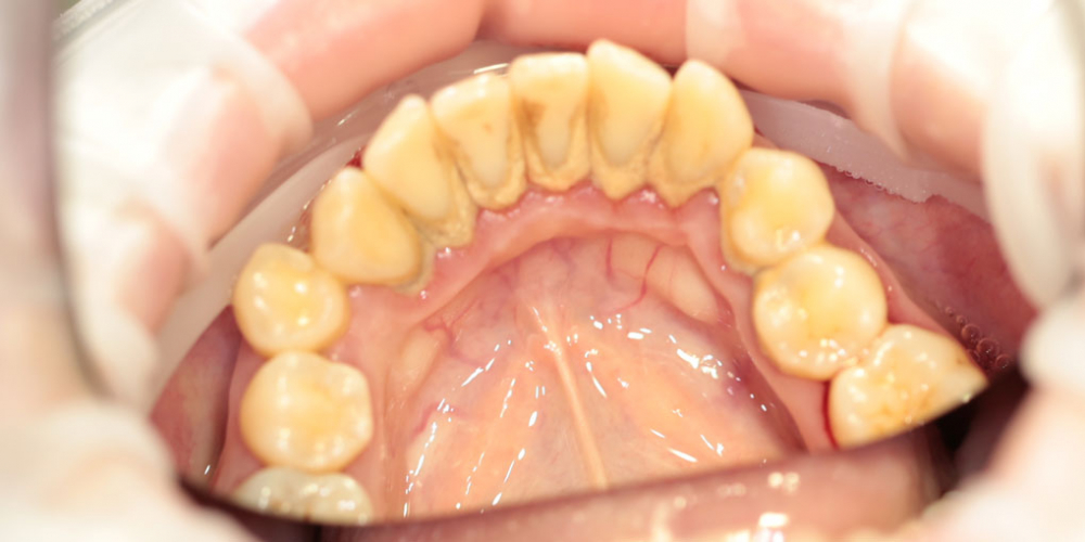  Жалобы на зубной камень, как следствие неприятный запах изо рта