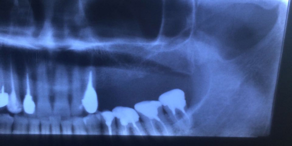 На снимке видно, что дно гайморовой  пазухи расположено низко, условия для имплантации отсутствуют Установка трех имплантантов в области отсутствия зубов на верхней челюсти слева