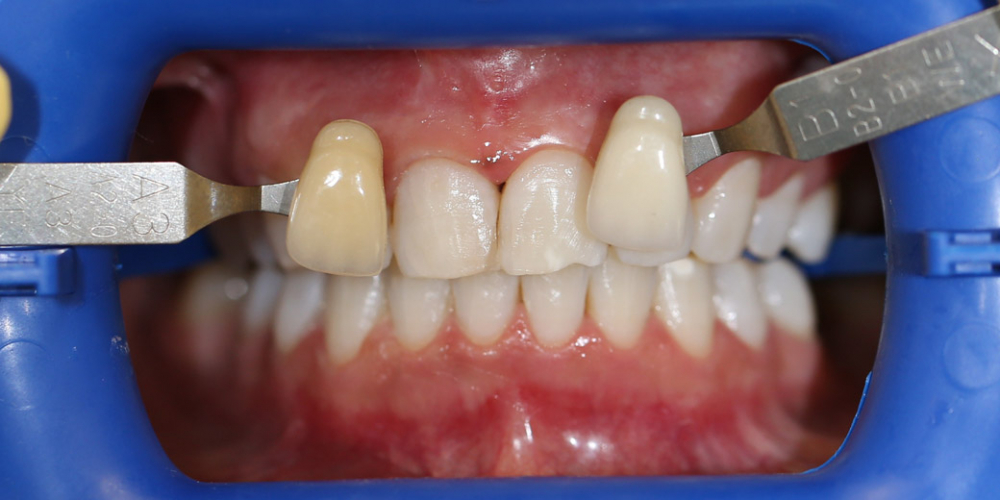  Результат отбеливания зубов системой ZOOM 3
