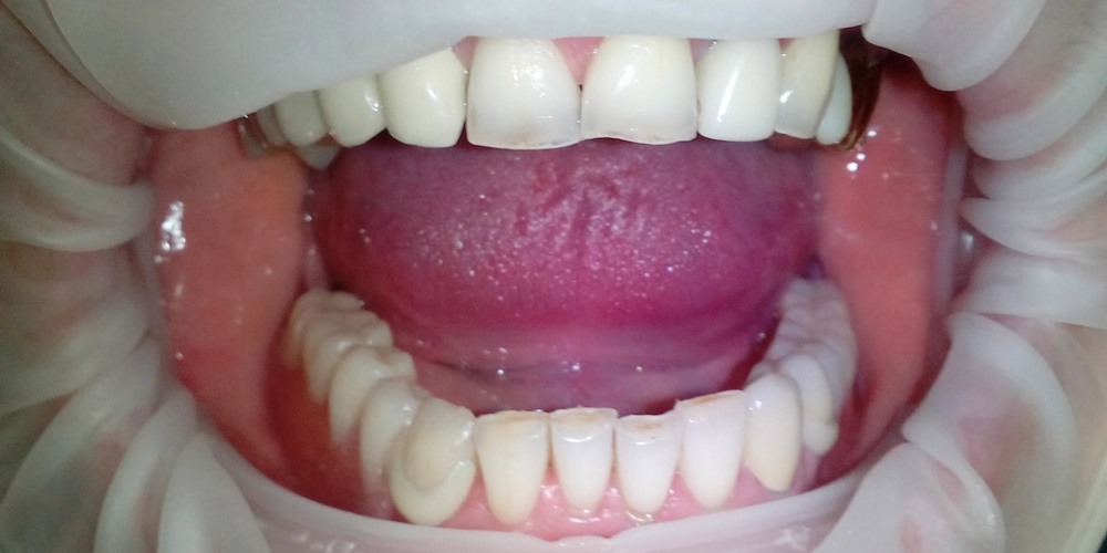 Пациент Г., 63 года. Пациент после проведенного протезирования. В полости рта на нижней челюсти установлен съемный протез на ацеталовом базисе (dentalD). Протезирование съемным протезом на ацеталовом базисе
