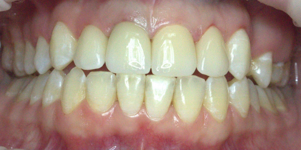  Коронки из диоксида циркония на центральные зубы
