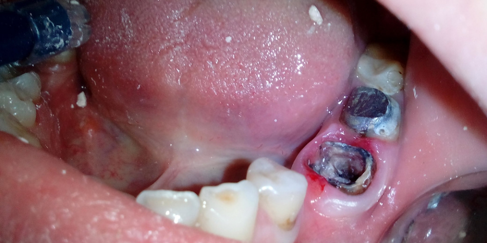 Фото до начала работы. В полости рта имеется разрушенный зуб и отсутствующий зуб. Изготовлен и зафиксирован металлокерамический мостовидный протез