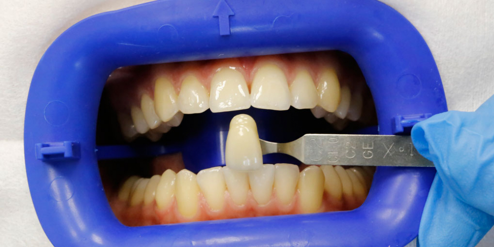  Результат отбеливание зубов системой Zoom 3