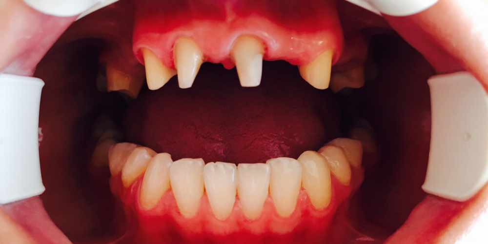 Пациент П., 22 лет, После проведенного компьютерного моделирования, полученные параметры были перенесены в полость рта и проведена обработка зубов. Получены слепки высокоточным слепочным материалом.  Протезирование верхней челюсти металлокерамическим мостовидным протезом
