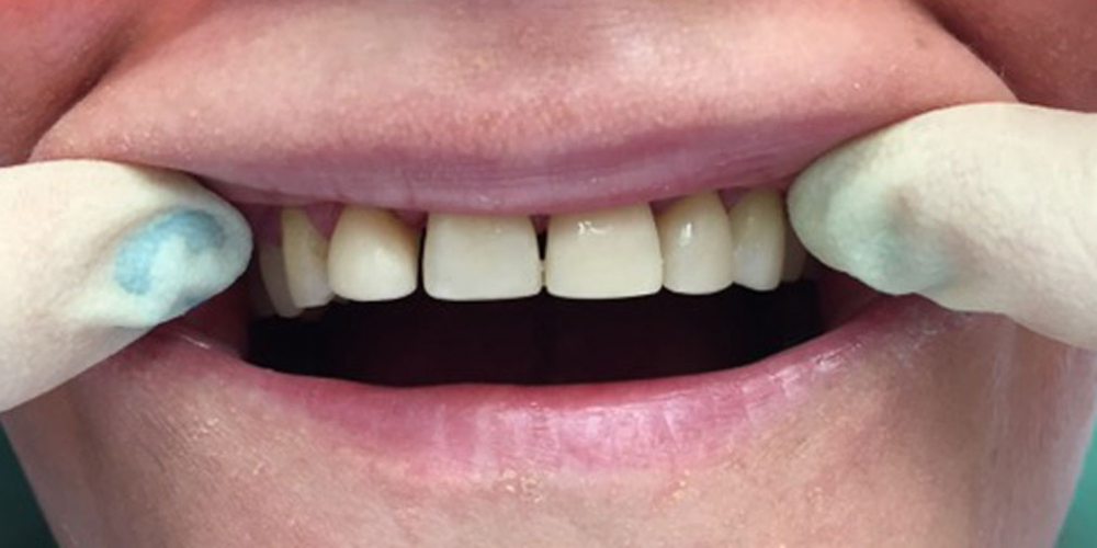  Прямая реставрация фронтальной группы зубов с помощью компазитного материала Estelite