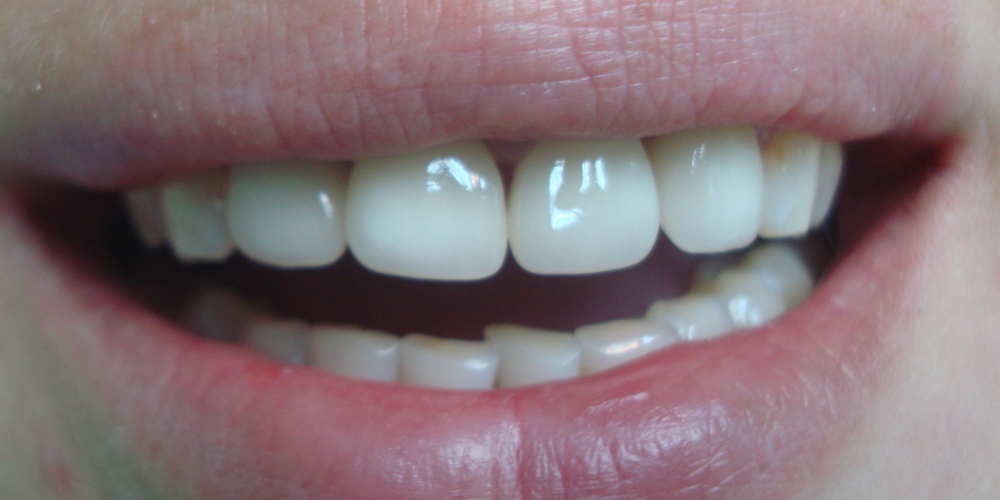  Преображение цвета и формы передних зубов (верхний ряд)