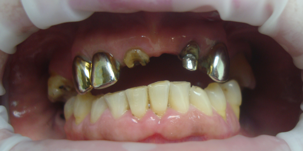  Восстановление отсутствующих зубов несъемным мостовидным протезом