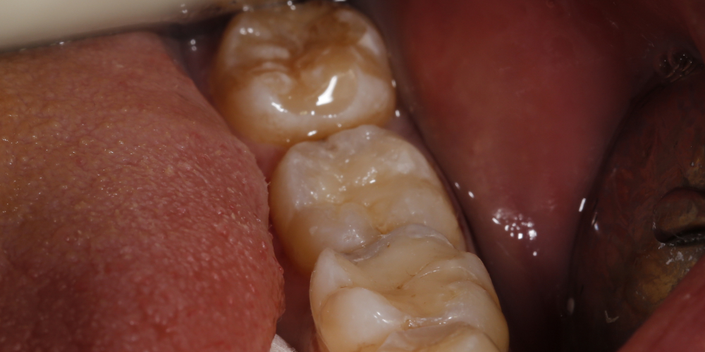  Рецидивный кариес зуба 36