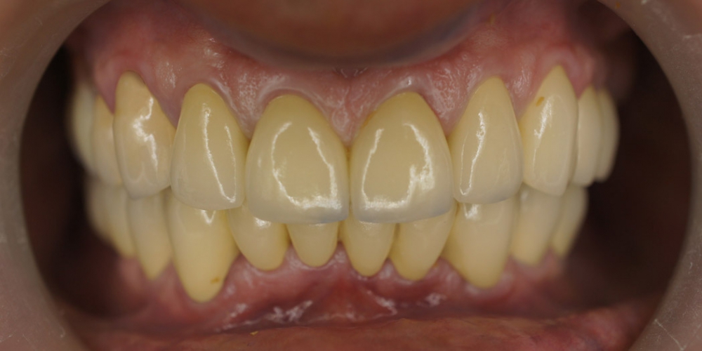  Пациент обратился с жалобами на эстетику зубов верхний и нижней челюсти