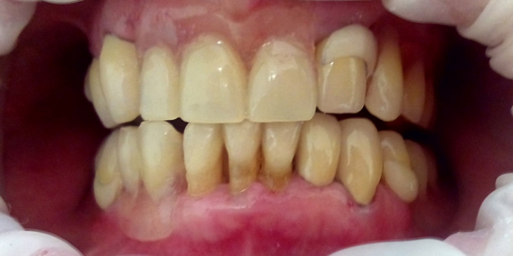 Пациент Б.,68 лет. Пациент после протезирования. Вид в полости рта. Результат протезирования зубов верхней и нижней челюсти