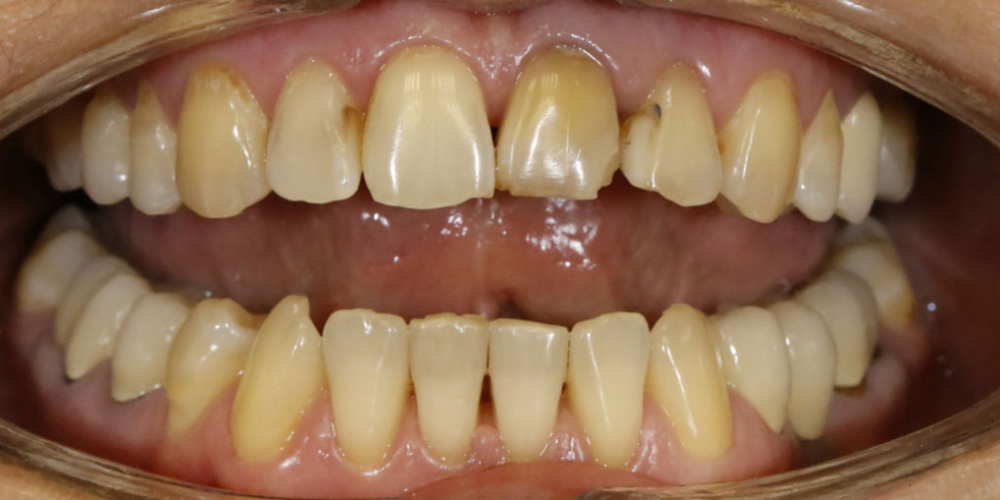  Преображение цвета и формы передних зубов