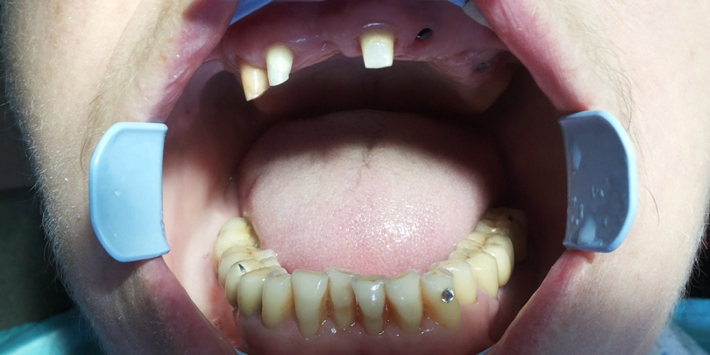 Установлены имплантанты в области отсутствующих зубов верхней челюсти. Получены слепки для протезирования. Имплантация зубов с протезированием несъемным керамическим протезом