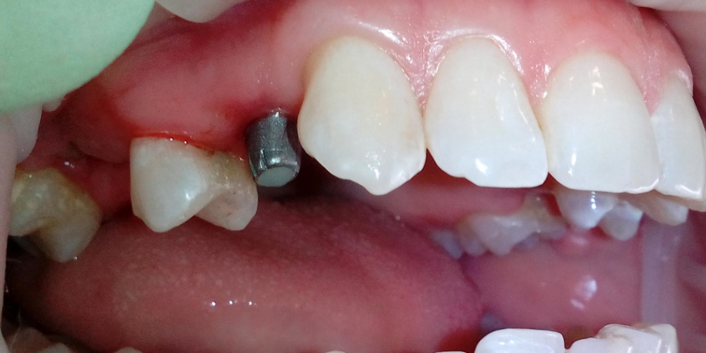 Фото на этапе работы. В области отсутствующего зуба установлен абатмент. Протезирование зуба на верней челюсти справа на ранее установленном имплантанте