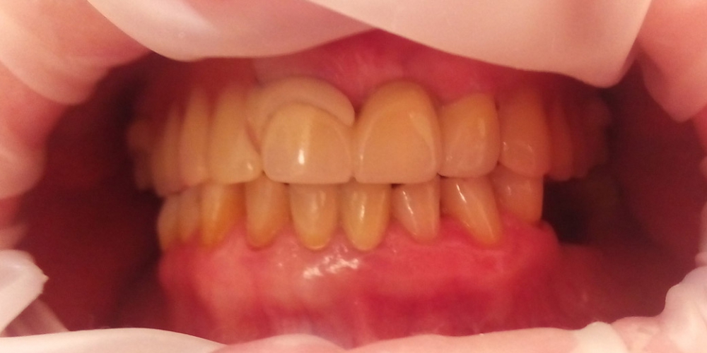Пациент после проведенного лечения и на этапе протезирования. Центральные зубы восстановлены металлокерамическими коронками.                                                                   Полное протезирование нижней и верхней челюсти