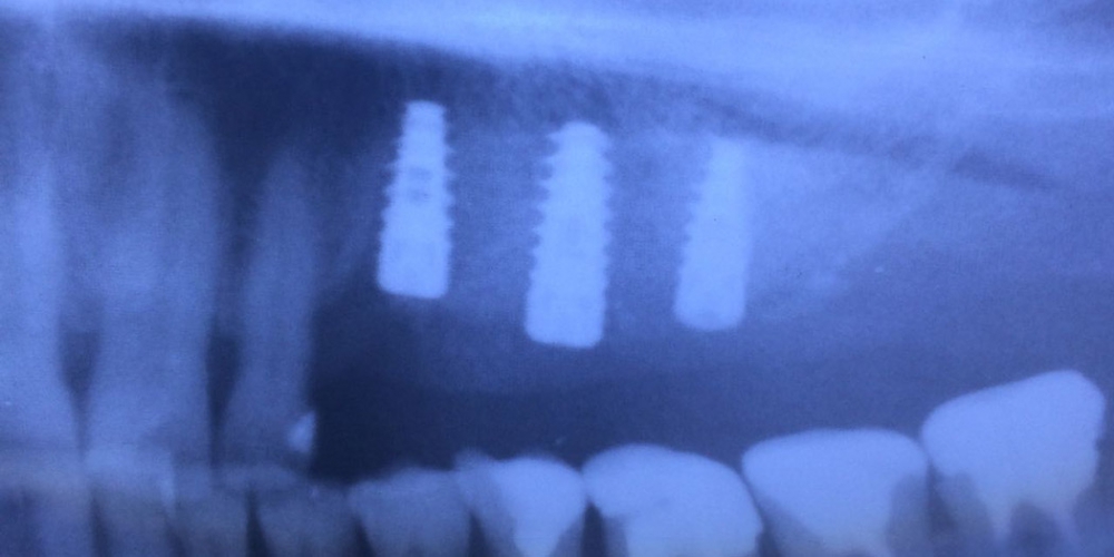Под местной анестезией создан доступ к дну гайморовой  пазухи.

Результат операции. Дно гайморовой пазухи поднято, установлено три имплантанта в проекции 4 5 6 зубов на верхней челюсти слева. Установка трех имплантантов в области отсутствия зубов на верхней челюсти слева