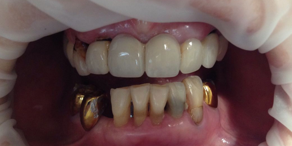 Фото до начала работы. В полости рта находятся старые протезы. Протезирования зубов верней и нижней челюсти