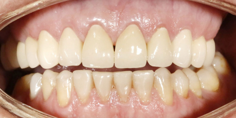  Восстановление верхних зубов керамическими коронками на основе диоксида циркония