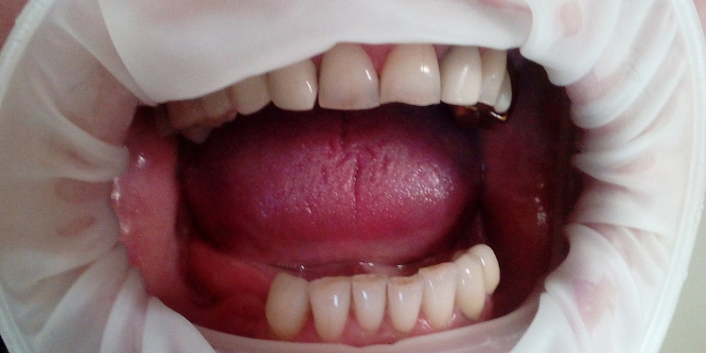 Пациент Г., 63 года. Пациент до начала работы. Определяется отсутствие зубов на нижней челюсти в боковых участках. Протезирование съемным протезом на ацеталовом базисе