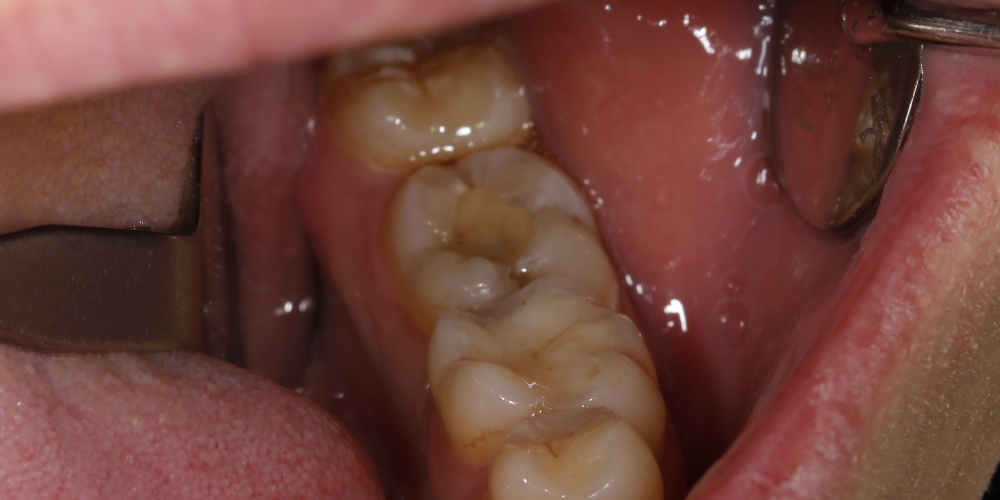  Рецидивный кариес зуба 36