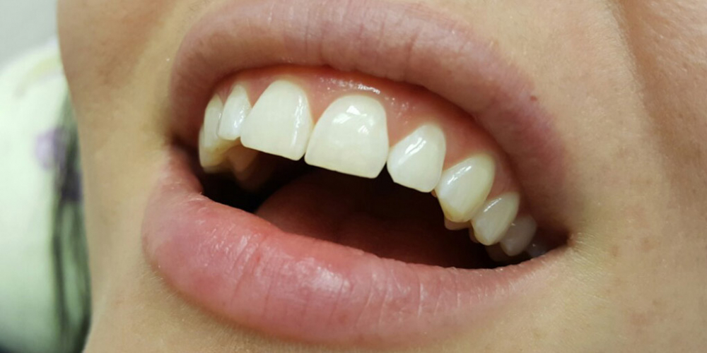  Неинвазивная реставрация скола переднего зуба