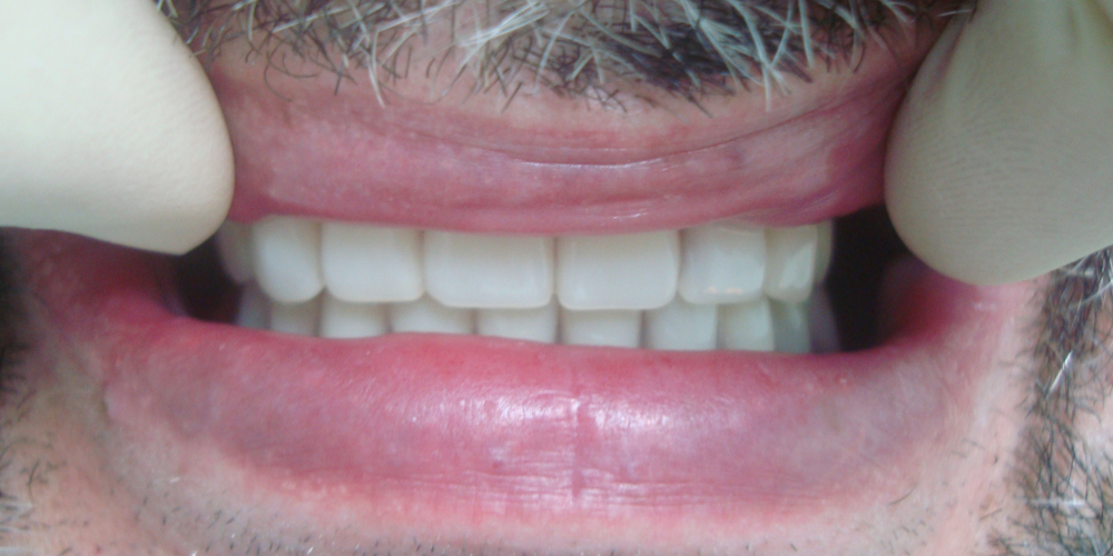 Конечный результат Восстановление зубов на верхней и нижней челюсти (полная адентия - отсутвуют все зубы)