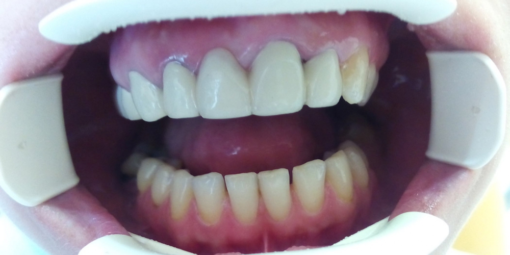 Изготовлен несъемный металлокерамический мостовидный протез и зафиксирован в полости рта. Протезирование зубов верхней челюсти металлокерамическим мостовидным протезом