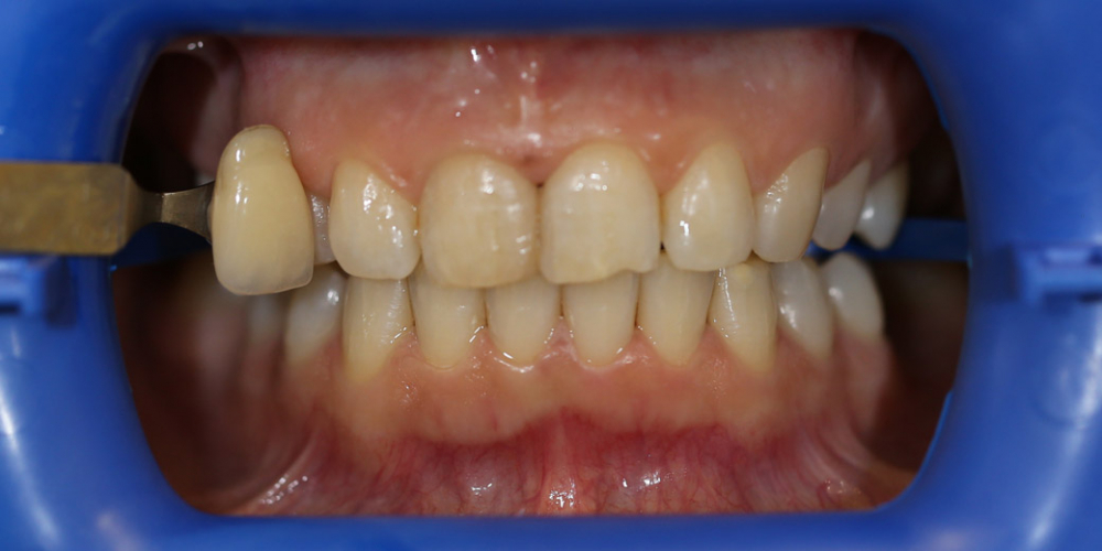  Результат отбеливания зубов системой ZOOM 3