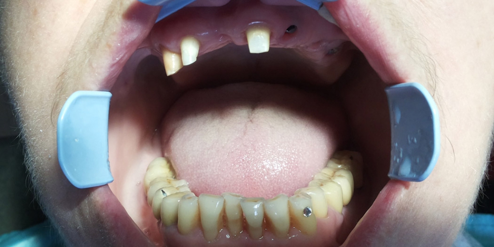 Пациент Т. 69 лет, Установлены имплантанты в области отсутствующих зубов верхней челюсти. Получены слепки для индивидуальной ложки. Протезирования зубов верней челюсти на имплантах