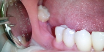 Протезирование металлокерамическим мостовидным протезом с опорой на три зуба фото до лечения