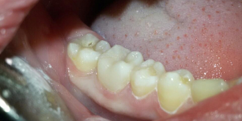 Жалоба на скол стенки зуба фото после лечения