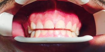 Протезирование передних зубов керамическими винирами импресс фото до лечения