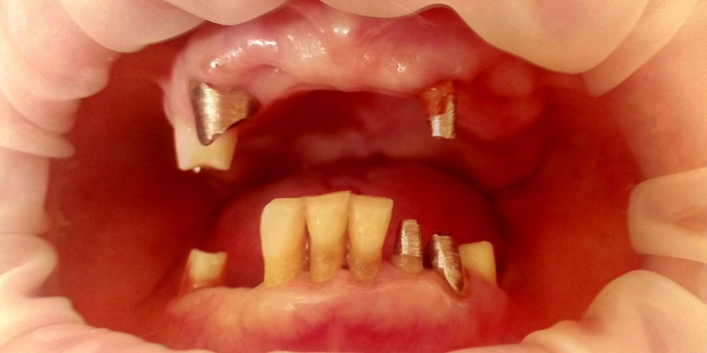 Пациент Б.,68 лет. Пациент после проведенного лечения. Разрушенные зубы восстановлены корневыми штифтовыми вкладками. Результат протезирования зубов верхней и нижней челюсти
