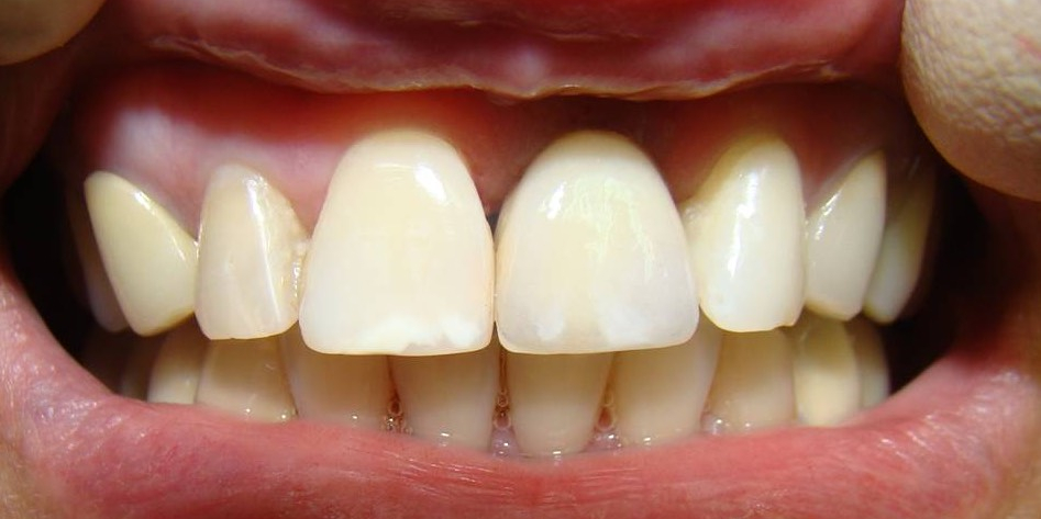 постоянная металлокерамическая коронка в полости рта Восстановление центрального резца на верхней челюсти при помощи мк коронкой на импланте