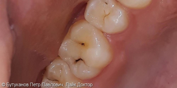 Проблема – кариес на четырех зубах фото до лечения
