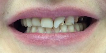Протезирование передних зубов коронками из диоксида циркония фото до лечения