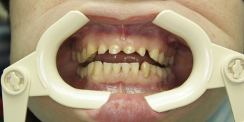 Реставрация зубов с применением композитных виниров фото до лечения