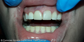 Художественная реставрация фронтальной поверхности зуба композитным материалом Estet X фото после лечения