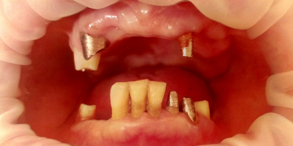Пациент на этапе протезирования. В полости рта установлены металлокерамические коронки. Протезирования зубов верней и нижней челюсти